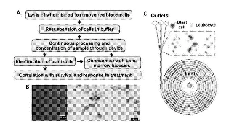 A rapid procedure for enriching blast cells from blood for leukemia detection. A) Procedural workflow. B) Merged brightfield and Hoechst staining for blast cells (left) and histopathological staining of enriched blast cells after processing (right). C) Layout of the closed-loop continuous flow system for rare cell enrichment. 