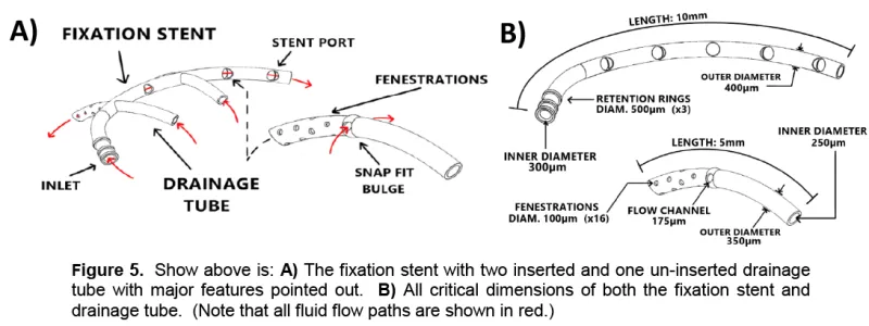Fixation Stent with Two Inserted and One Un-Inserted Drainage Tube & Dimensions