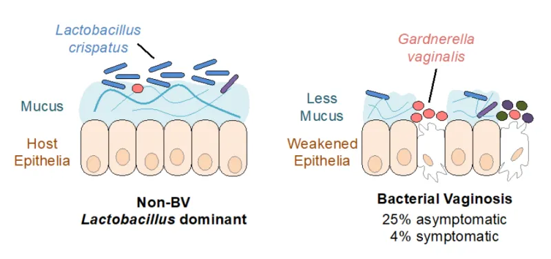 A depiction of a typical, healthy vaginal microbiome on the left where Lactobacillus predominately live in the mucus lining of the epithelia, and on the right is the state of bacterial vaginosis when Gardnerella vaginalis dominates and the mucus and epithelia are disrupted. 