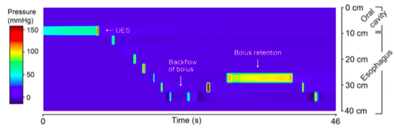Image 3: A pressure color plot displaying the measurements recorded in a simulation of the backflow and retention of a bolus in a porcine model. This backflow and retention may be seen in esophageal dysmotility disorders.